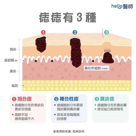 痣長毛原因|為什麼臉上的痣越來越多？皮膚科醫師解析長痣。